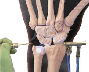 Physiotherapy wrist scope leaflet